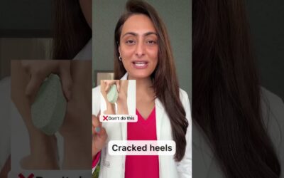 Cracked heels| How to manage | Dermatologist suggests