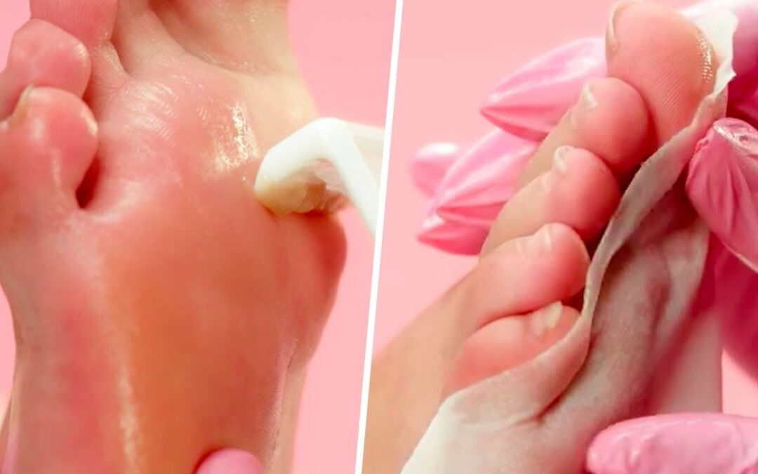 Extremely SATISFYING Calluspeeling – Foot Care