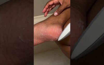 How to heal your cracked feet 👣