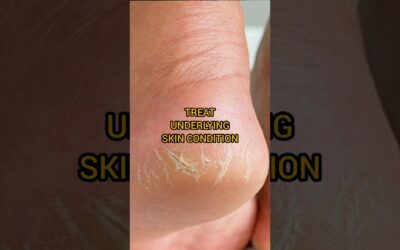 CRACKED HEELS | SKIN CARE TIPS | HEEL FISSURES | CRACKED FEET | FOOT CARE | SKIN CARE #viral